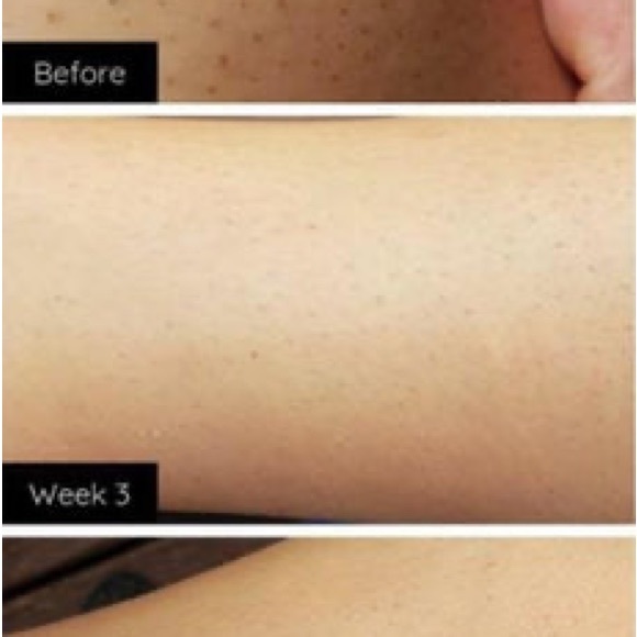 Happy Skin IPL Hair Removal - Picture 7 of 7